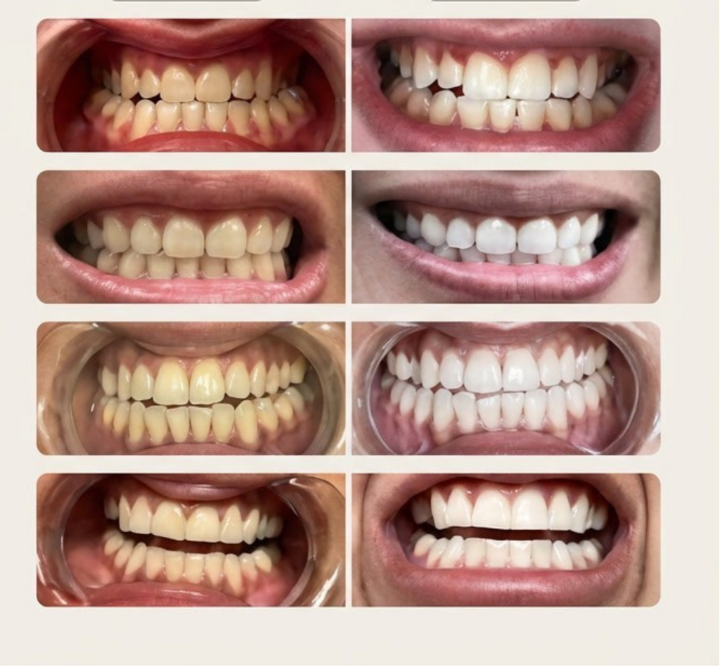 Professional Teeth Whitening Strips