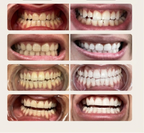 Professional Teeth Whitening Strips